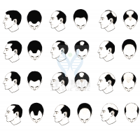 【U乐国际U乐基因检测】过早<font color='red'>脱发</font>、掉发太多怎么办？你的方法可能是错的！